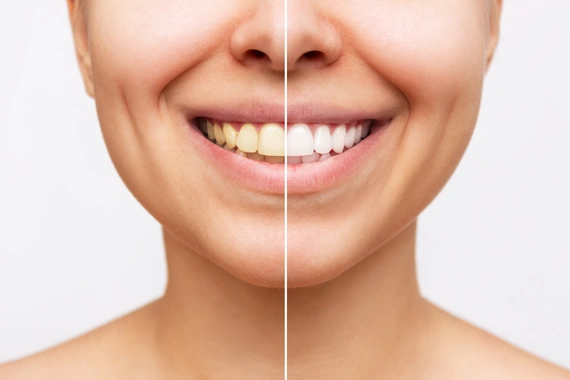 Teeth whitening