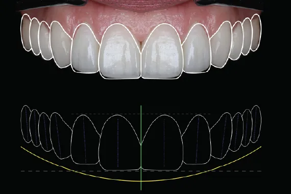 Smile design