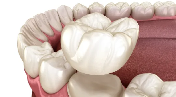 Dental crown