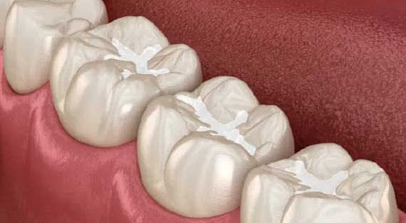 Dental fillings