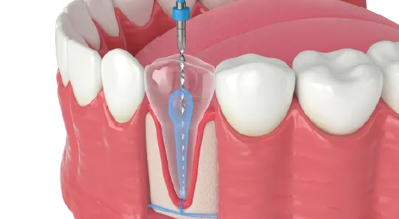 Root canal procedure