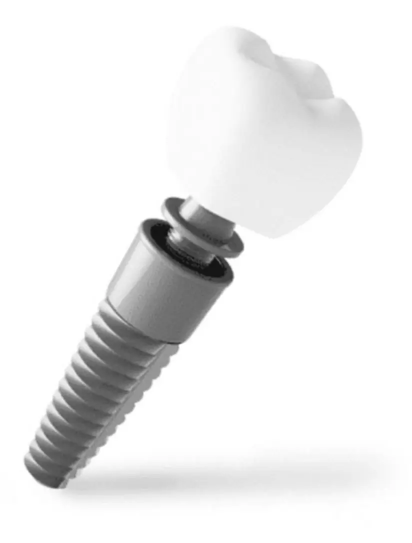 Dental implant
