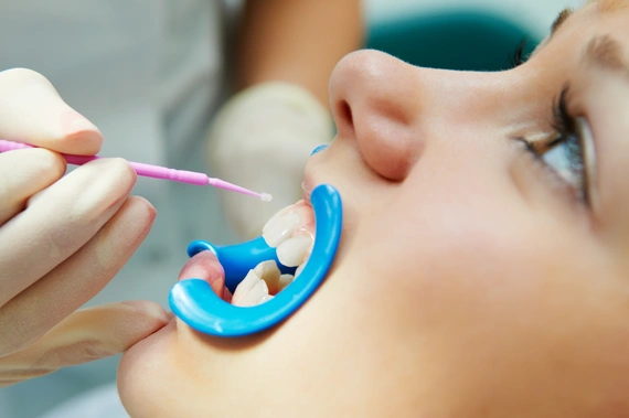 Dental sealants
