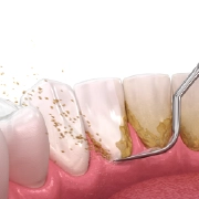 Dental Cleaning