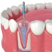 Endodontics