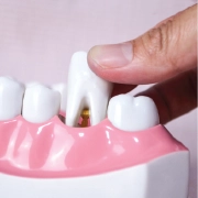Extractions