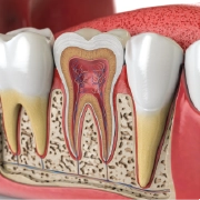 Root Canals