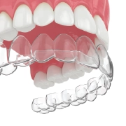 Invisalign