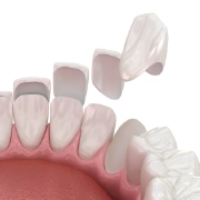 Veneers