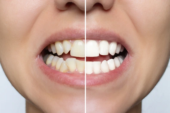Veneers before and after