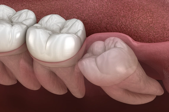 Wisdom tooth