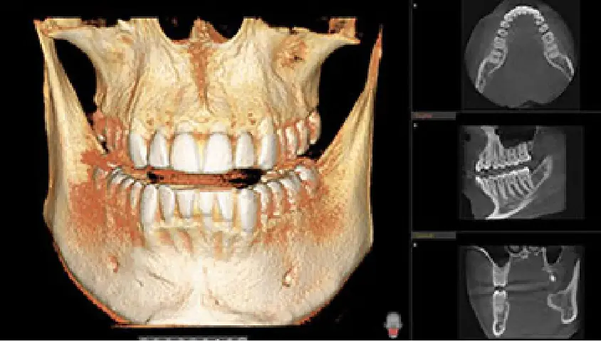 X-ray of dental implant